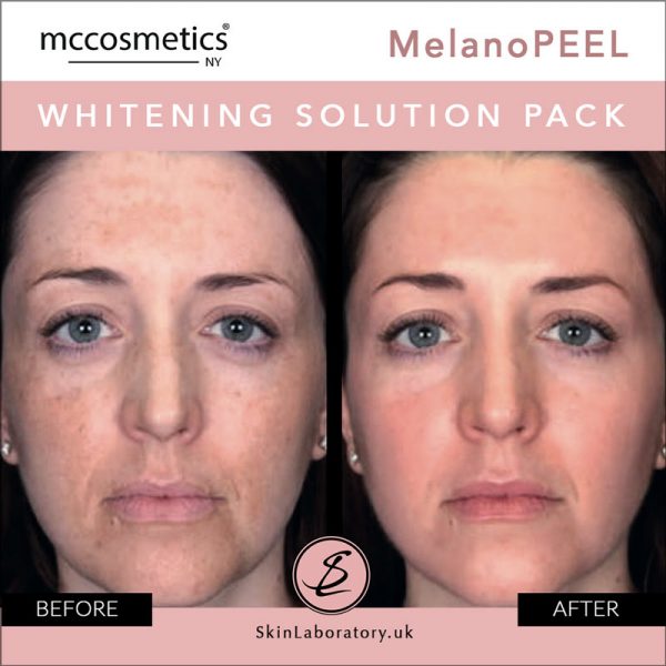Mccosmetics - Melanopeel Pack - professional procedure + home care image 2