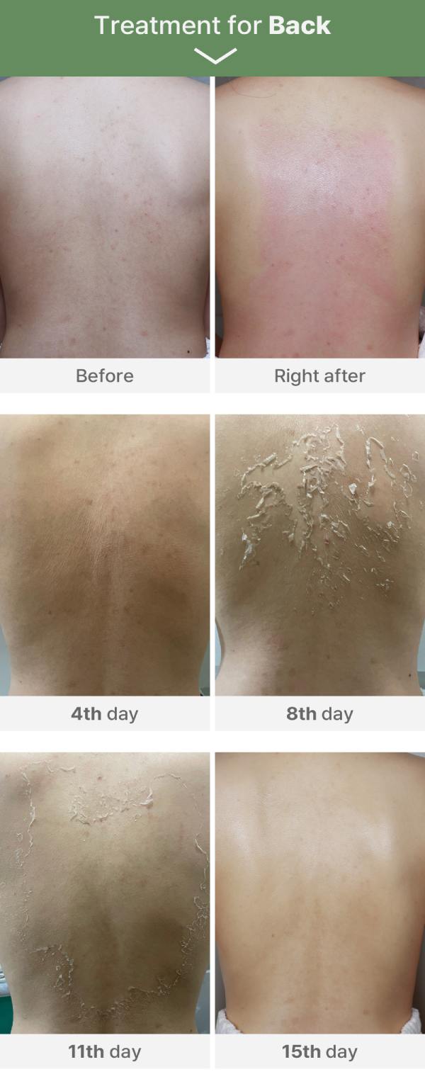 Medisco Peelieve Peeling image 8