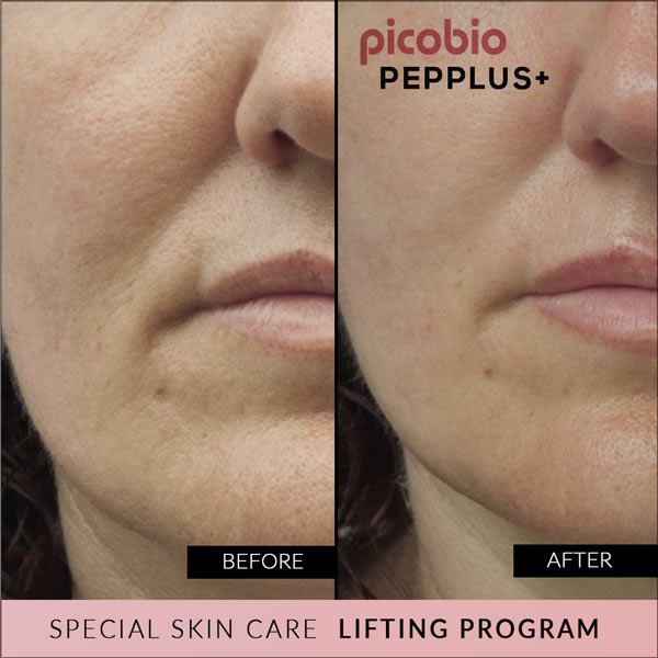 PicoBio PEPPLUS+ SUPER SkinCare Lifting Program - 10 treatments & wrinkle cream image 8