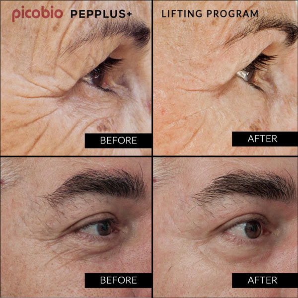 PicoBio PEPPLUS+ SUPER SkinCare Lifting Program - 10 treatments & wrinkle cream image 7
