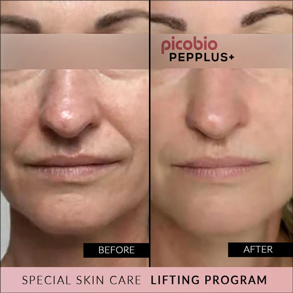 PicoBio PEPPLUS+ SUPER SkinCare Lifting Program - 10 treatments & wrinkle cream image 9