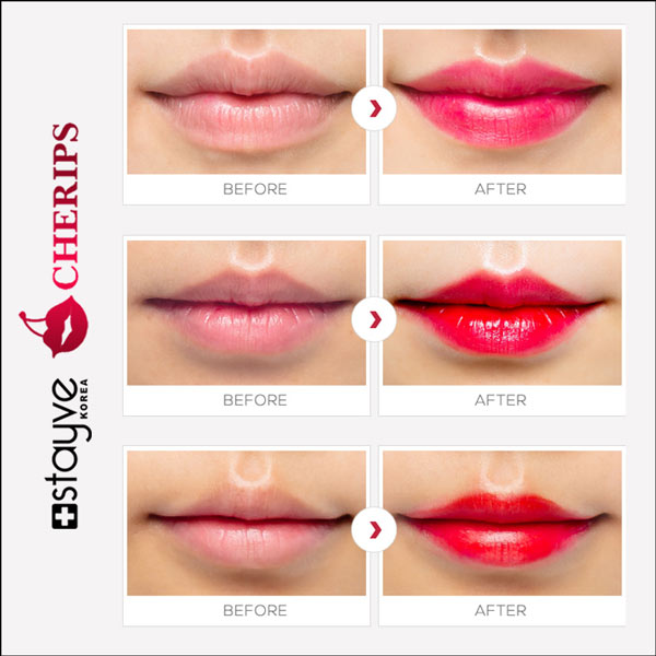 Stayve Cherips Micro-needling Ampoules Set for Lips (Copy) image 5