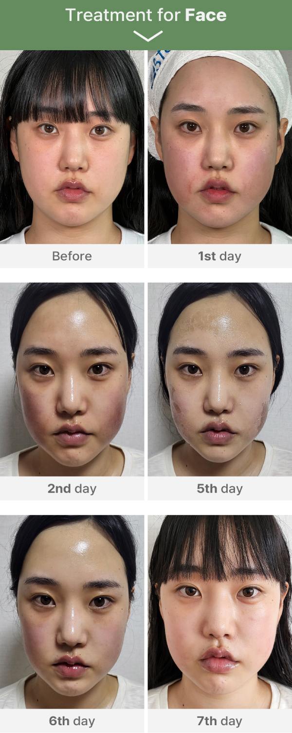 Medisco Peelieve Peeling image 7